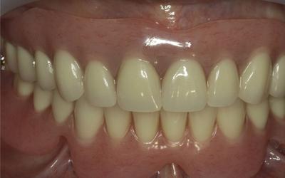 Initial situation with removable denture in upper and lower jaw.