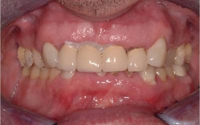 Failing restorations maxillary anterior with recent splinting of fractured/decayed #8 (US) / #11(FDI).