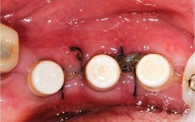 Initial occlusal view.