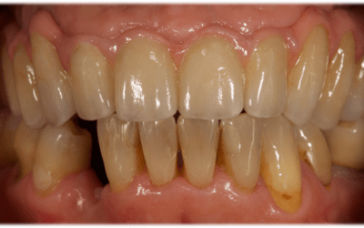 Initial situation, overview. Lower right canine missing. Fixed metal-ceramic bridge on implants in maxilla. 