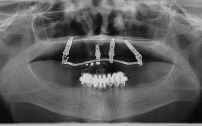 Initial panoramic radiograph shows bone loss around the failing implants.
