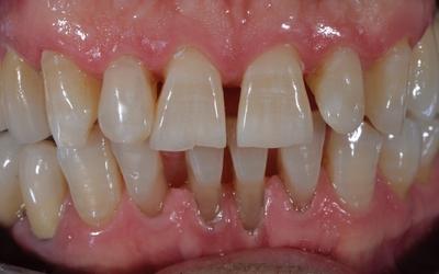 Initial situation, close-up frontal view of the occlusion. The interdental spaces and recessions are  clearly visible.