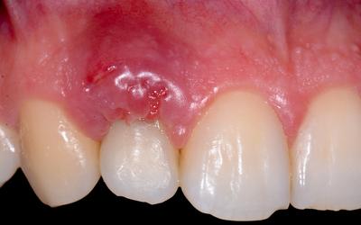 Inflammation around tooth #12 (FDI) / #7 (US).