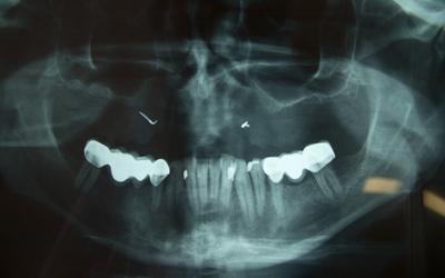 Initial panoramic radiograph.