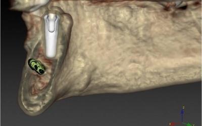 Initial implant position #35 (FDI).