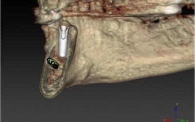 Initial implant position #36 (FDI).