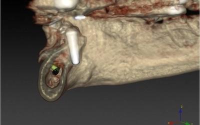 Initial implant position #37 (FDI).