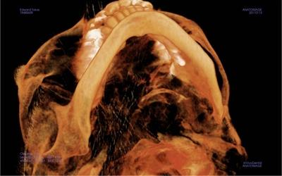 CT scan with mal-positioned implants.