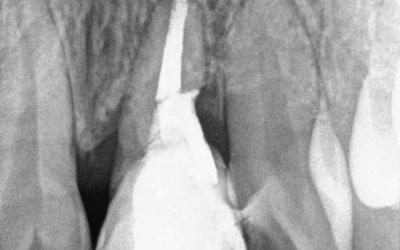 实施贴面 3 个月后的根尖周 X 光片：牙根继续萎缩，必须拔除该牙齿。
