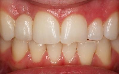 Clinical situation 2 months postcementation.