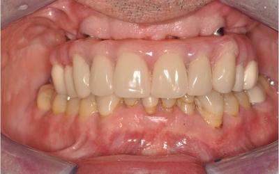 3-month post-operative retracted view. Definitive restoration to have an additional molar on each side, cantilevered distally from the second bicuspids.