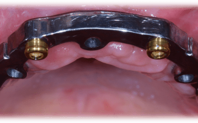 1-year follow-up: close-up view of the implant bar.
