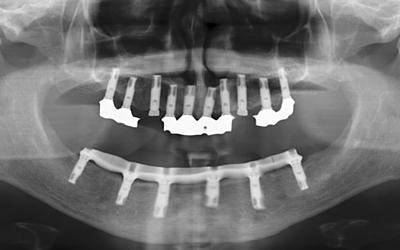 7 year follow-up x-ray.jpg