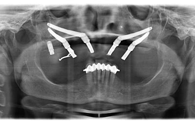 Follow-up panoramic radiograph.