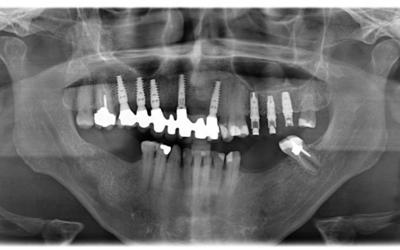 Panoramic radiograph at delivery of the definitive prosthesis.