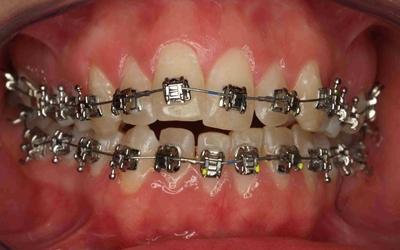 Intraoral frontal photograph on the day that fixed orthodontic appliances were placed. Damon System 2 braces were used with 0.014 copper NiTi round arch for both upper and lower arches. This orthodontic system uses passive self-ligating braces (using a 'sliding door' system as opposed to elastics to bond the arch and braces), designed to reduce friction from the braces on the orthodontic wire, promoting faster tooth movements with smaller forces. 