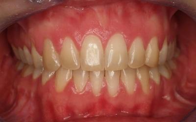 Intra-oral frontal view post-treatment. Note the open bite had been corrected and the teeth had been aligned. 