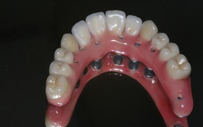 Definitive restoration maxilla: Nobel Procera Implant Bridge with individual Nobel Procera crowns and a customized acrylic gingival veneer.