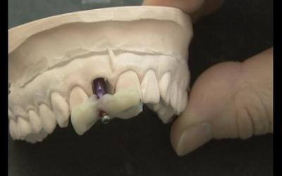 Provisional crown fabrication - transfer of implant position with impression coping & light-curing acrylic.