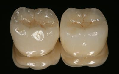  Both crowns in facial-occlusal view.