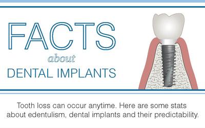 Dental Implant facts