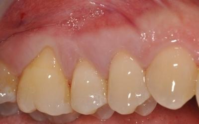 Gingival recession coverage with a xenogenic collagen matrix