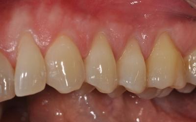 Gingival recession coverage with a xenogenic collagen matrix