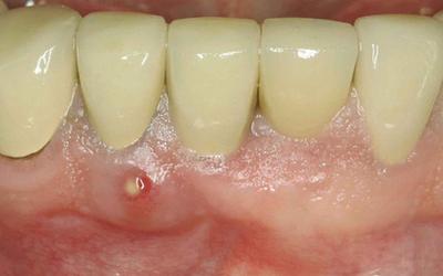 Peri-implant pathology risk assessment tool