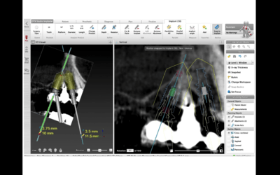 Treatment of a fractured root using dynamic navigated surgery by Dr. Luca De Stavola