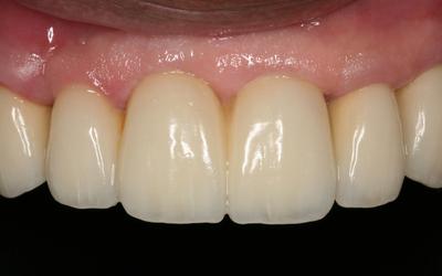 3-unit Maxillary FPD attached to 3 implants. Due to the use of 3mm diameter implants and the somewhat tall crowns, a fixed prosthesis was used that splinted the implants to help distribute the occlusal forces.