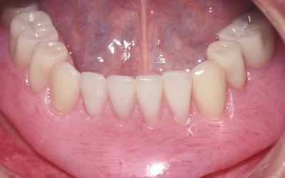 Frontal view of mandibular overdenture.