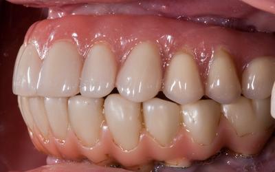 Provisional denture in situ