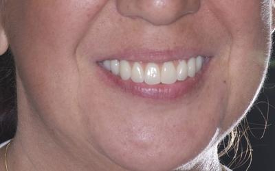 Definitive reconstruction with a big increase in esthetic appearance.