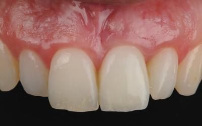 最终修复体被非常和谐的牙龈轮廓包围。牙齿 #21 (FDI)/#9（美国）的轴线和长度已校正，具有非常自然的外观。