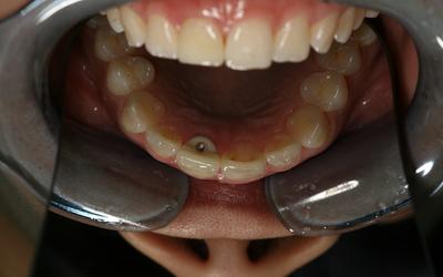 Delivery of srew-retained definitive crown - occlusal view in mirror.