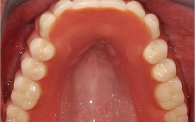 Intraoral view of the definitive restoration.