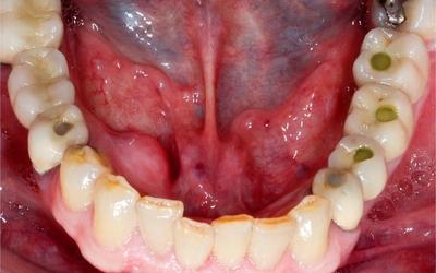 Occlusal view of definitive restoration.