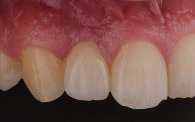 Frontal view of the definitive single crown 6 months after implant placement.