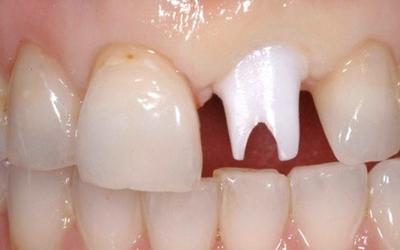Abutment placement after cleaning and disinfection of components, note initial blanching and abutment has been carefully adjusted and shaped so that the labial gingival margin is at the correct level.