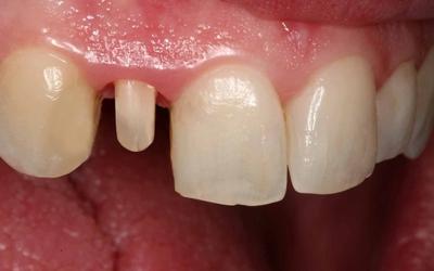 Tooth preparation at placement appointment after gingiva responded favorably to provisional crown contours and smoothness.
