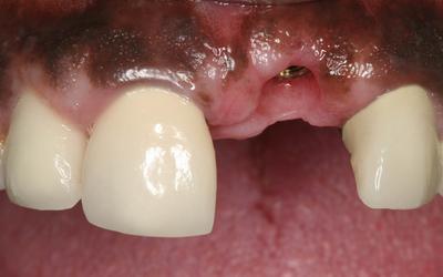 Implant placed and mucosa healed but deficient in volume.