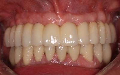 Frontal view of definitive restorations.