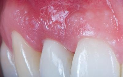 Frontal view of the final crown at the moment of placement (18 weeks after implant placement). Note the natural integration of the crown with the soft tissues, and the harmony of the final crown with the adjacent teeth.