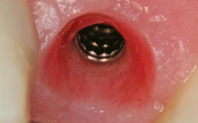 Peri-implant mucosa at time of cementation.