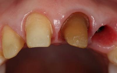 Tooth preparations - inciso-facial view.
