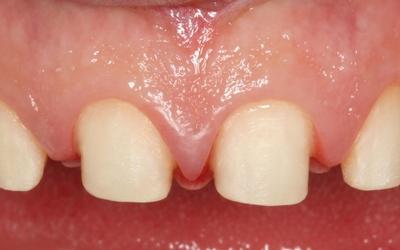 Tooth preparation for all-ceramic single crowns.