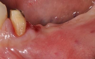 Mandibular ridge before surgery. Tooth #34 (FDI) / #21 (US) will be extracted and replaced by an implant. 