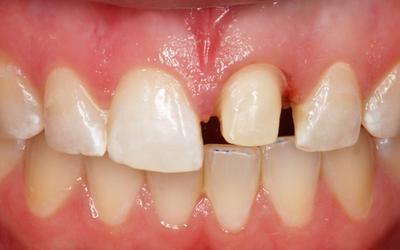 Tooth prepared for all-ceramic crown with shoulder finish line.