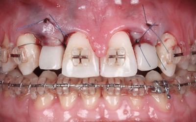 Clinical situation after placement of the implants, soft tissue management and immediate loading with temporary resin crowns.