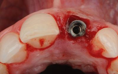 在进行牙龈粘膜手术的同时进行种植体植入。
